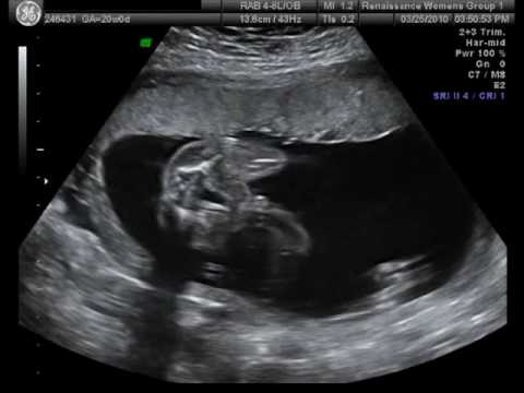 pregnancy dating scan what to expect