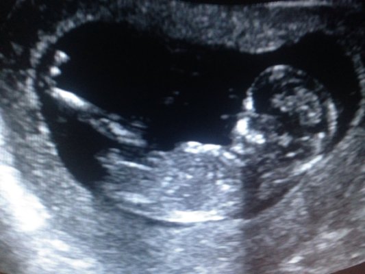 what to expect at 8 week dating scan